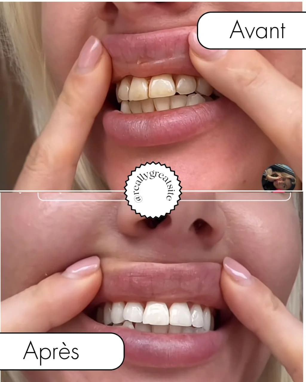 Bandes dentaires 5D White — visuel 3